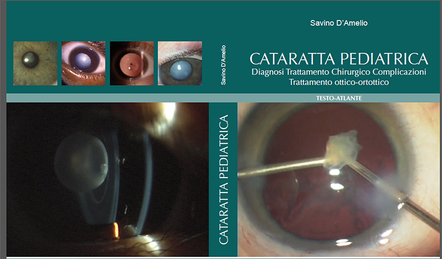 Cover cataratta pediatrica copia