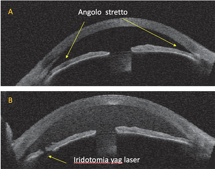 Iridotomia yag laser