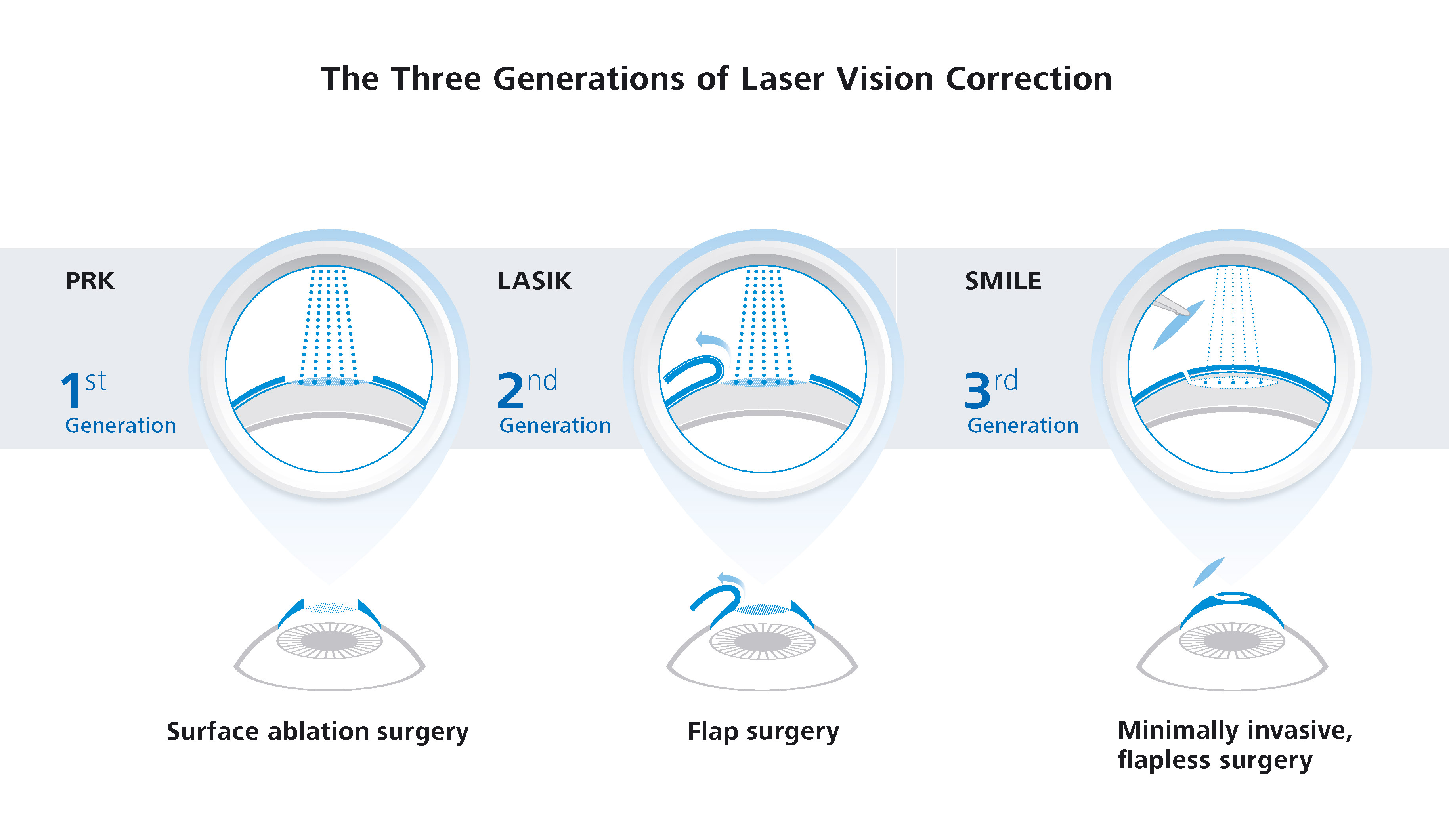 3Generations SMILE LASIK PRK withText EN 34 065 0002I