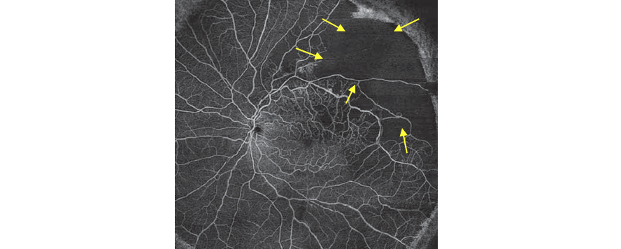 ischemia