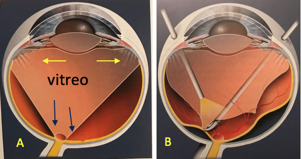 traz. vitreo maculare